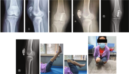 扎骨针怎么装髌骨下极粉碎骨折怎么办？7种固定技术详解与术式选择_https://www.jmylbn.com_新闻资讯_第10张