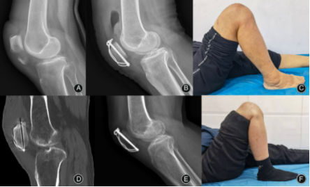 扎骨针怎么装髌骨下极粉碎骨折怎么办？7种固定技术详解与术式选择_https://www.jmylbn.com_新闻资讯_第13张