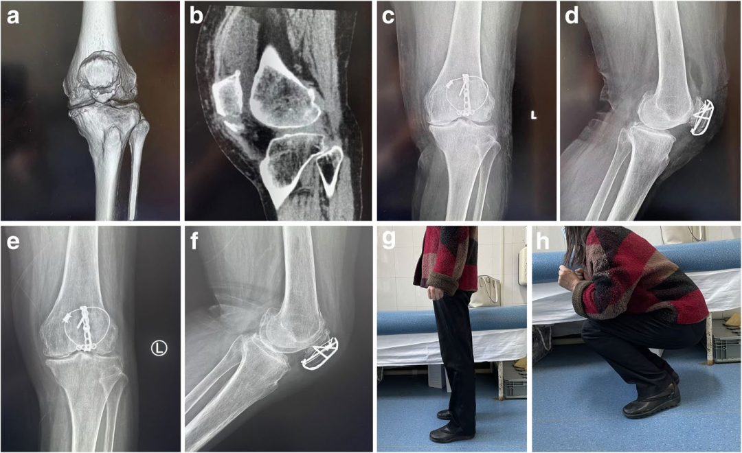 扎骨针怎么装髌骨下极粉碎骨折怎么办？7种固定技术详解与术式选择_https://www.jmylbn.com_新闻资讯_第3张