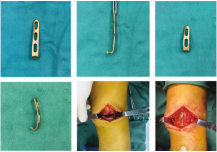 扎骨针怎么装髌骨下极粉碎骨折怎么办？7种固定技术详解与术式选择_https://www.jmylbn.com_新闻资讯_第8张