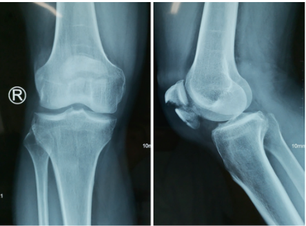 扎骨针怎么装髌骨下极粉碎骨折怎么办？7种固定技术详解与术式选择_https://www.jmylbn.com_新闻资讯_第15张