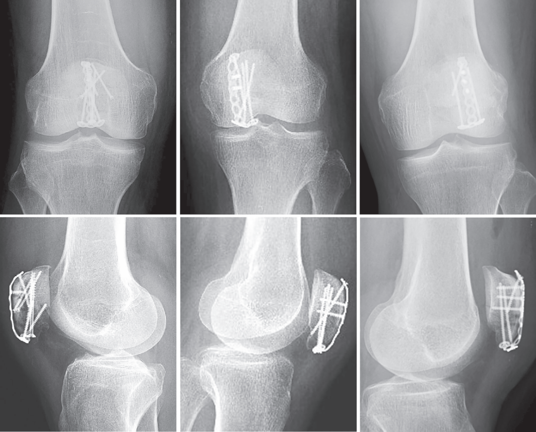 扎骨针怎么装髌骨下极粉碎骨折怎么办？7种固定技术详解与术式选择_https://www.jmylbn.com_新闻资讯_第19张