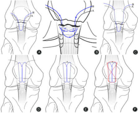 扎骨针怎么装髌骨下极粉碎骨折怎么办？7种固定技术详解与术式选择_https://www.jmylbn.com_新闻资讯_第11张