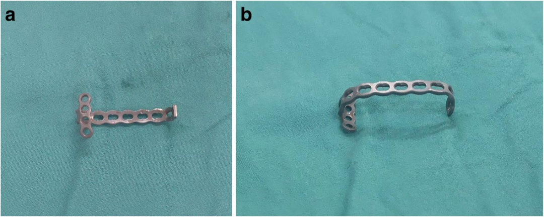 扎骨针怎么装髌骨下极粉碎骨折怎么办？7种固定技术详解与术式选择_https://www.jmylbn.com_新闻资讯_第1张