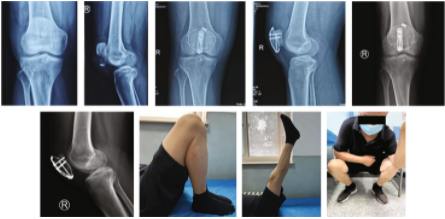 扎骨针怎么装髌骨下极粉碎骨折怎么办？7种固定技术详解与术式选择_https://www.jmylbn.com_新闻资讯_第9张