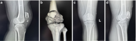 扎骨针怎么装髌骨下极粉碎骨折怎么办？7种固定技术详解与术式选择_https://www.jmylbn.com_新闻资讯_第4张
