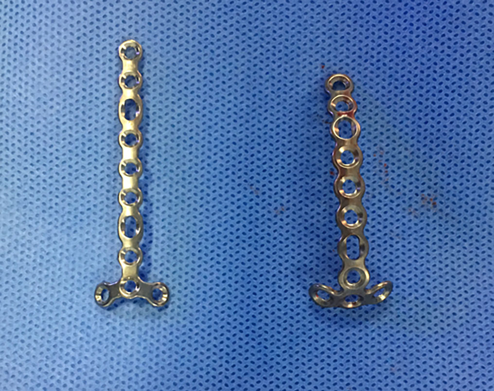 扎骨针怎么装髌骨下极粉碎骨折怎么办？7种固定技术详解与术式选择_https://www.jmylbn.com_新闻资讯_第17张