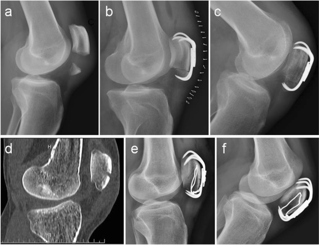 扎骨针怎么装髌骨下极粉碎骨折怎么办？7种固定技术详解与术式选择_https://www.jmylbn.com_新闻资讯_第27张