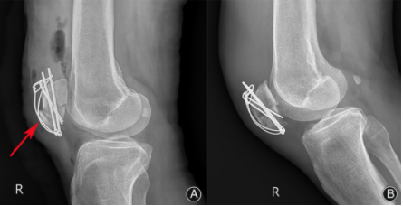 扎骨针怎么装髌骨下极粉碎骨折怎么办？7种固定技术详解与术式选择_https://www.jmylbn.com_新闻资讯_第14张
