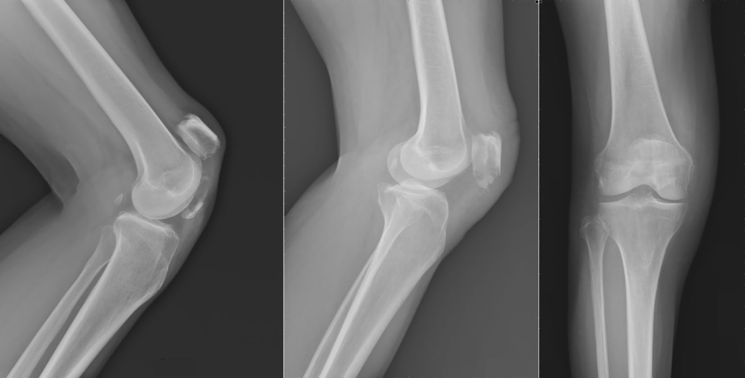 扎骨针怎么装髌骨下极粉碎骨折怎么办？7种固定技术详解与术式选择_https://www.jmylbn.com_新闻资讯_第22张