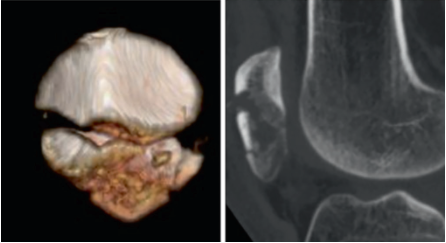 扎骨针怎么装髌骨下极粉碎骨折怎么办？7种固定技术详解与术式选择_https://www.jmylbn.com_新闻资讯_第16张