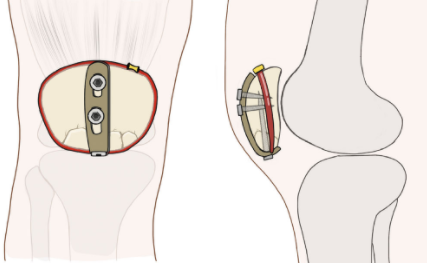 扎骨针怎么装髌骨下极粉碎骨折怎么办？7种固定技术详解与术式选择_https://www.jmylbn.com_新闻资讯_第7张