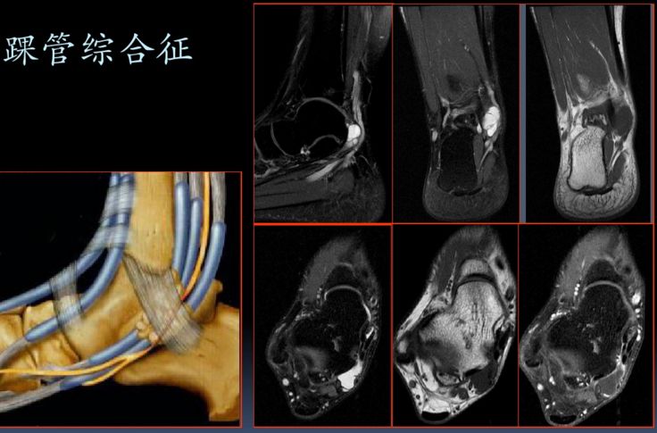 踝关节mri大全