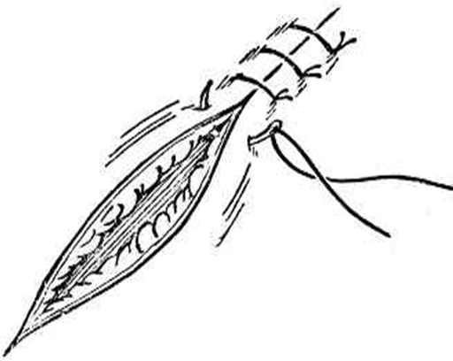 缝合怎么换药外科“清创+缝合+换药”，这些技能你都Get了吗？_https://www.jmylbn.com_新闻资讯_第1张