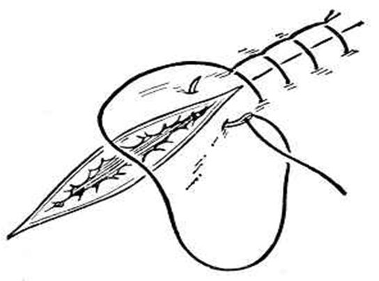 缝合怎么换药外科“清创+缝合+换药”，这些技能你都Get了吗？_https://www.jmylbn.com_新闻资讯_第4张