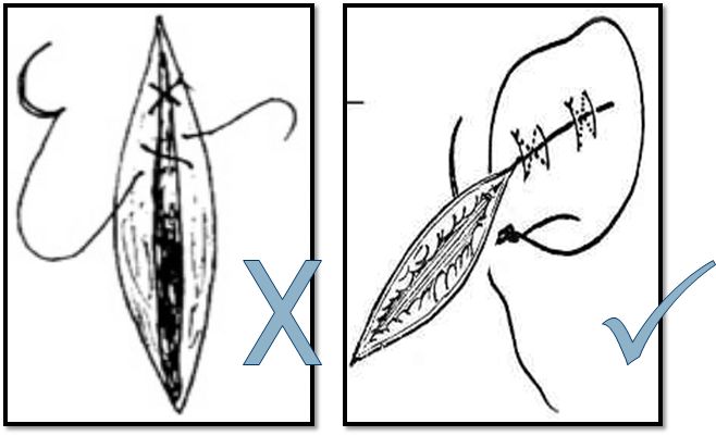 缝合怎么换药外科“清创+缝合+换药”，这些技能你都Get了吗？_https://www.jmylbn.com_新闻资讯_第3张