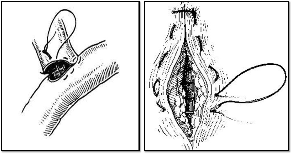缝合怎么换药外科“清创+缝合+换药”，这些技能你都Get了吗？_https://www.jmylbn.com_新闻资讯_第12张