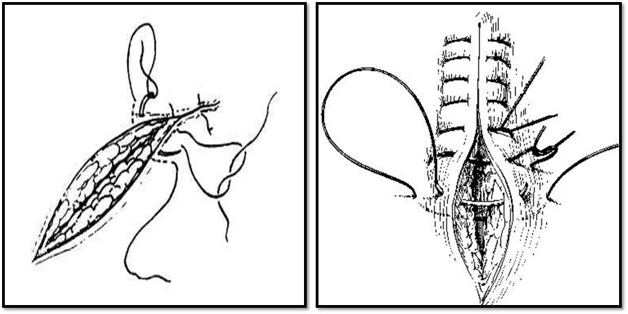 缝合怎么换药外科“清创+缝合+换药”，这些技能你都Get了吗？_https://www.jmylbn.com_新闻资讯_第10张