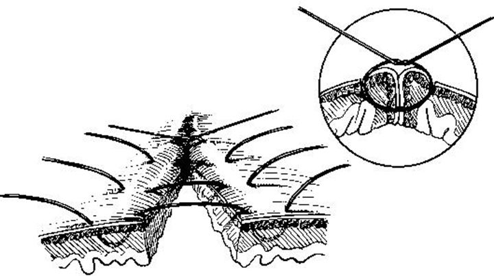 缝合怎么换药外科“清创+缝合+换药”，这些技能你都Get了吗？_https://www.jmylbn.com_新闻资讯_第6张