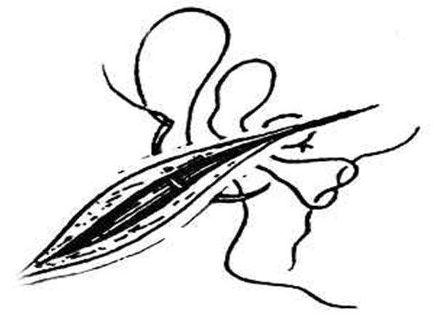 缝合怎么换药外科“清创+缝合+换药”，这些技能你都Get了吗？_https://www.jmylbn.com_新闻资讯_第11张