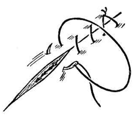 缝合怎么换药外科“清创+缝合+换药”，这些技能你都Get了吗？_https://www.jmylbn.com_新闻资讯_第2张