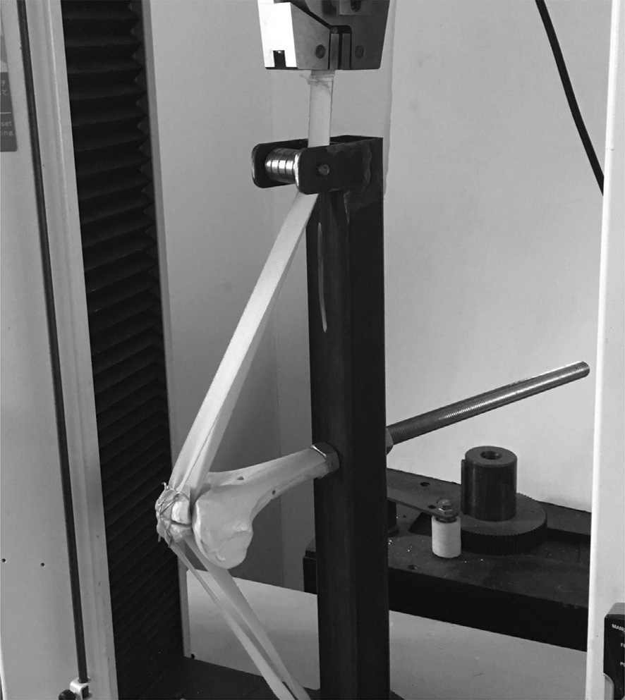 Illustration 4 for 骨科必读：优化Weber改良张力带！K氏针1.8mm精准定位，如何防止2mm移位，彻底终结髌骨骨折难题？