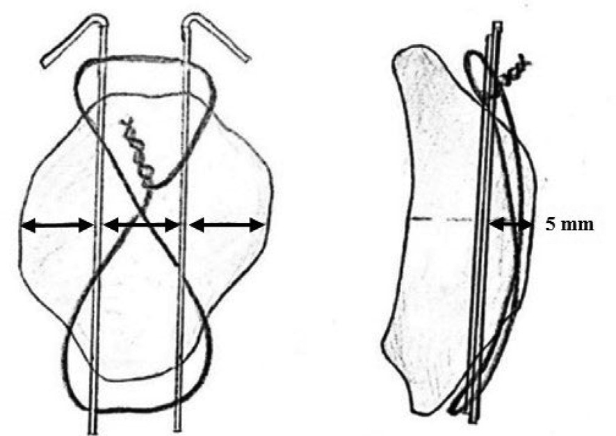 Illustration 1 for 骨科必读：优化Weber改良张力带！K氏针1.8mm精准定位，如何防止2mm移位，彻底终结髌骨骨折难题？