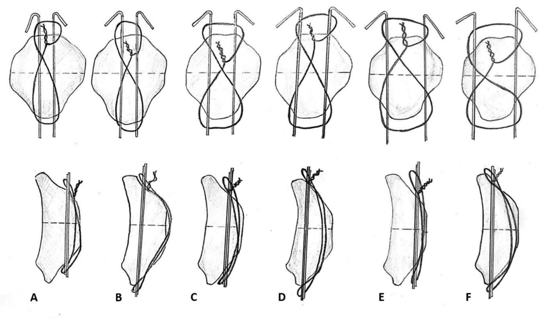 Illustration 3 for 骨科必读：优化Weber改良张力带！K氏针1.8mm精准定位，如何防止2mm移位，彻底终结髌骨骨折难题？