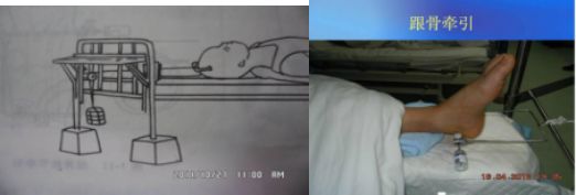 什么病忌用翻身床为什么临床必会 ｜ 15种骨科常见病的最佳术后体位+功能锻炼_https://www.jmylbn.com_新闻资讯_第2张