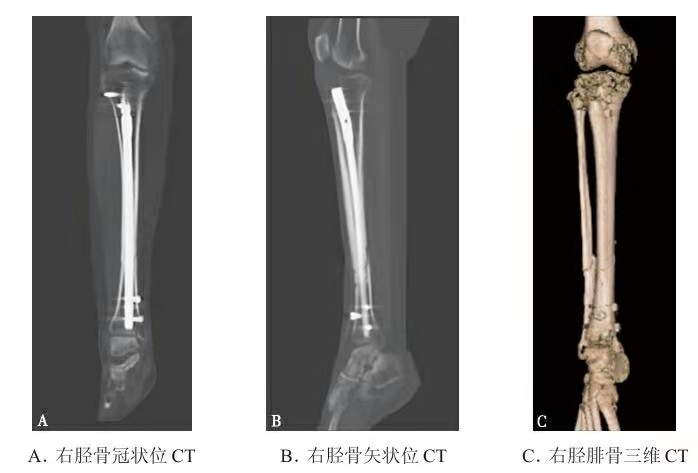 病例详解 判断骨折愈合状态的手段与方法 骨今中外 微信公众号文章阅读 Wemp