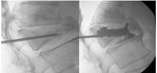 老年人椎体骨折怎么办——经皮椎体成形术
