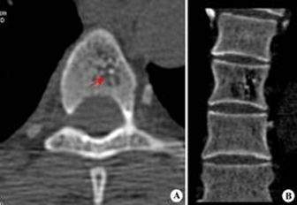 老年人椎体骨折怎么办——经皮椎体成形术