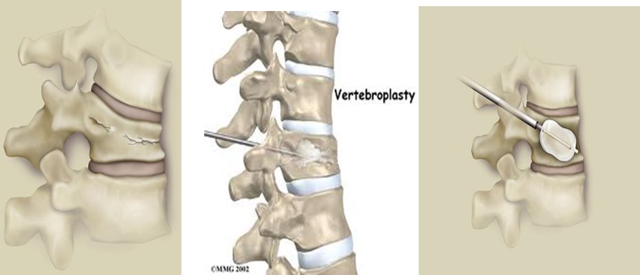 老年人椎体骨折怎么办——经皮椎体成形术