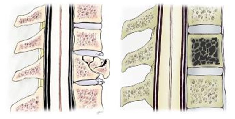 老年人椎体骨折怎么办——经皮椎体成形术