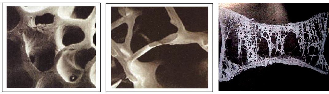 老年人椎体骨折怎么办——经皮椎体成形术