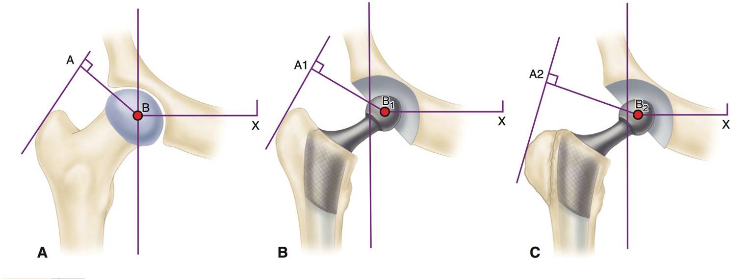 专题教程髋关节置换术后的不稳