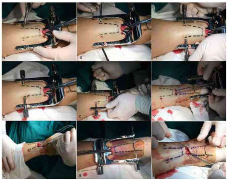 缝合器都有哪些厂家跟腱断裂常用的四种缝合修复方法，你都知道吗？_https://www.jmylbn.com_新闻资讯_第6张