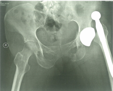 Illustration 5 for 全髋关节置换术后脱位为何高发？骨科专家揭秘核心原因，助您掌握预防与应对完整指南！