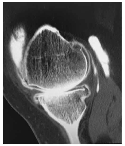 为什么会有单关节器械膝关节单踝置换术：美国观点和全球的观点-上海聚慕医疗器械有限公司