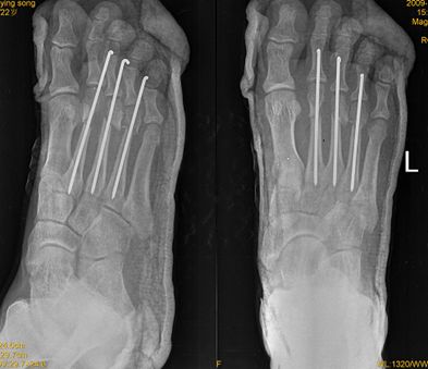 足部骨折的分類及治療 看這篇就夠了 骨今中外 微文庫