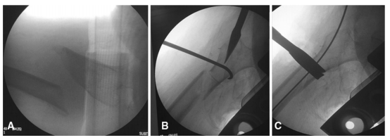 大腿取钢丝怎么麻醉股骨粗隆下骨折复位技巧，最新文献总结来了！_https://www.jmylbn.com_新闻资讯_第5张