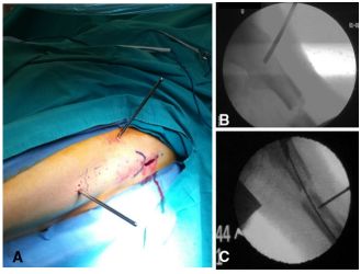 大腿取钢丝怎么麻醉股骨粗隆下骨折复位技巧，最新文献总结来了！_https://www.jmylbn.com_新闻资讯_第2张