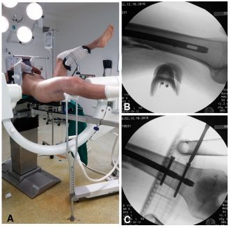 大腿取钢丝怎么麻醉股骨粗隆下骨折复位技巧，最新文献总结来了！_https://www.jmylbn.com_新闻资讯_第1张