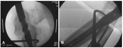 大腿取钢丝怎么麻醉股骨粗隆下骨折复位技巧，最新文献总结来了！_https://www.jmylbn.com_新闻资讯_第4张
