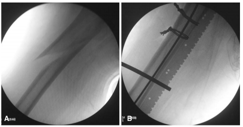 大腿取钢丝怎么麻醉股骨粗隆下骨折复位技巧，最新文献总结来了！_https://www.jmylbn.com_新闻资讯_第8张