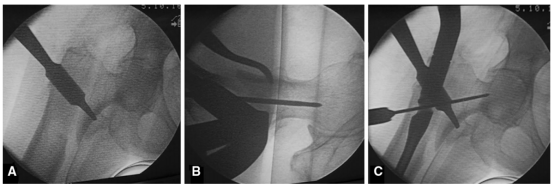 大腿取钢丝怎么麻醉股骨粗隆下骨折复位技巧，最新文献总结来了！_https://www.jmylbn.com_新闻资讯_第3张