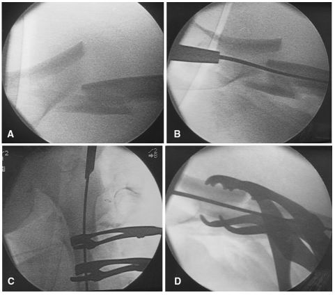 大腿取钢丝怎么麻醉股骨粗隆下骨折复位技巧，最新文献总结来了！_https://www.jmylbn.com_新闻资讯_第7张