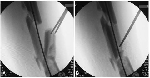 大腿取钢丝怎么麻醉股骨粗隆下骨折复位技巧，最新文献总结来了！_https://www.jmylbn.com_新闻资讯_第6张