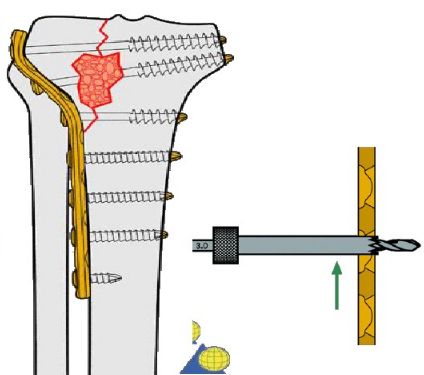 生物钉是什么材料骨折常用内固定材料&选择原则，超详细！_https://www.jmylbn.com_新闻资讯_第18张