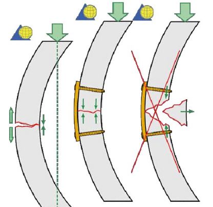 生物钉是什么材料骨折常用内固定材料&选择原则，超详细！_https://www.jmylbn.com_新闻资讯_第5张